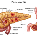 pancreatitis